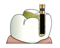 Flat End Cylinder